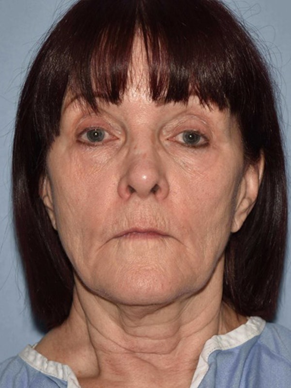 Facelift Before & After Gallery - Patient 173566406 - Image 1