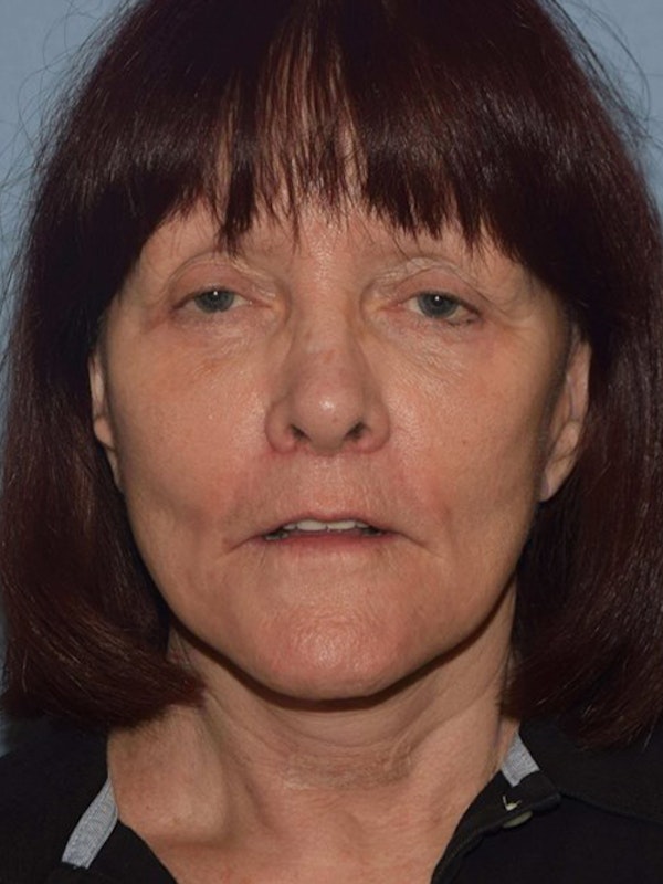 Facelift Before & After Gallery - Patient 173566406 - Image 2