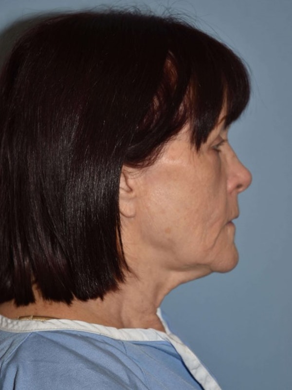 Facelift Before & After Gallery - Patient 173566406 - Image 5