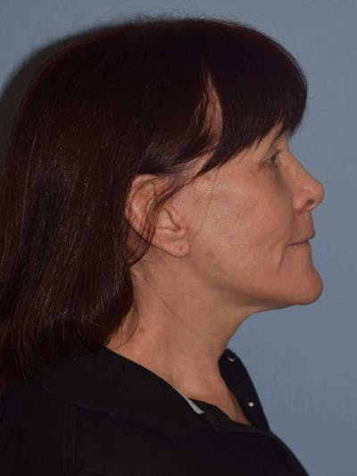Facelift Before & After Gallery - Patient 173566406 - Image 6