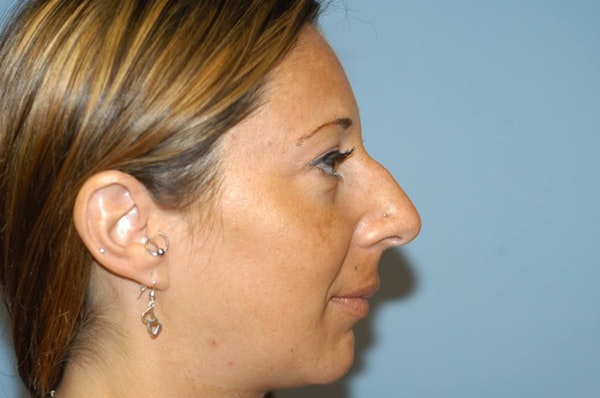 Rhinoplasty Before & After Gallery - Patient 173566415 - Image 1