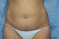Tummy Tuck Before & After Gallery - Patient 173566413 - Image 1