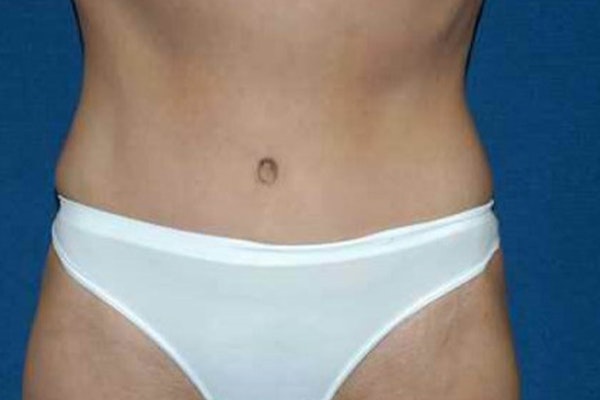 Tummy Tuck Before & After Gallery - Patient 173566413 - Image 2