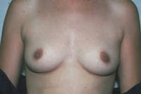 Breast Augmentation Before & After Gallery - Patient 173566419 - Image 1