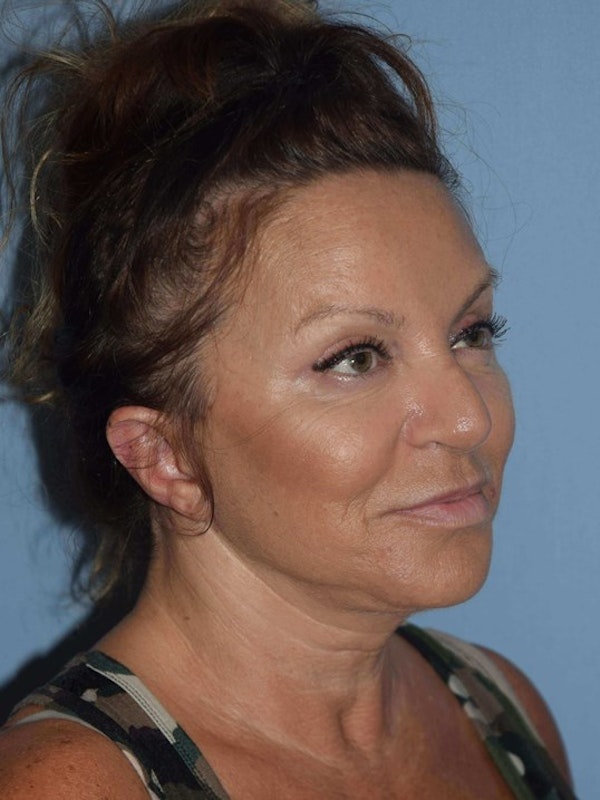 Facelift Before & After Gallery - Patient 173566416 - Image 4