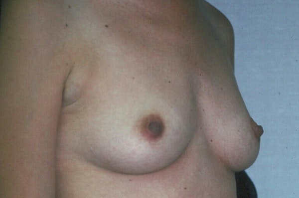 Breast Augmentation Before & After Gallery - Patient 173566419 - Image 3