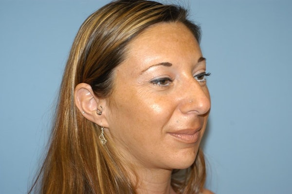 Rhinoplasty Before & After Gallery - Patient 173566415 - Image 5