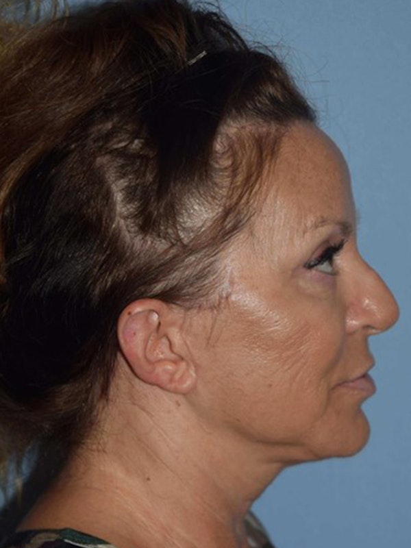 Facelift Before & After Gallery - Patient 173566416 - Image 6