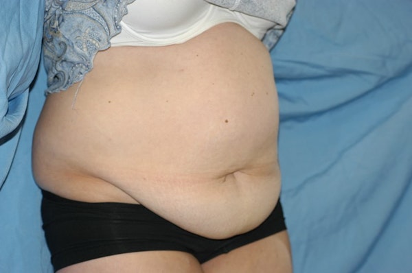 Tummy Tuck Before & After Gallery - Patient 173566421 - Image 3