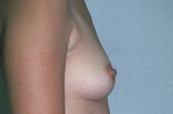 Breast Augmentation Before & After Gallery - Patient 173566419 - Image 5