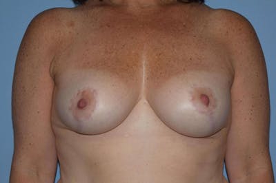 Breast Reduction Before & After Gallery - Patient 173566422 - Image 2