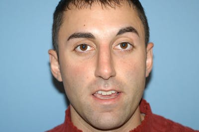 Rhinoplasty Before & After Gallery - Patient 173566423 - Image 4
