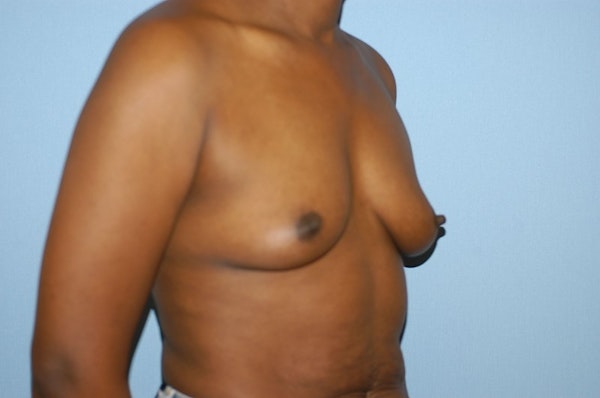 Breast Augmentation Before & After Gallery - Patient 173566424 - Image 3