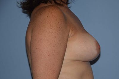 Breast Reduction Before & After Gallery - Patient 173566422 - Image 6