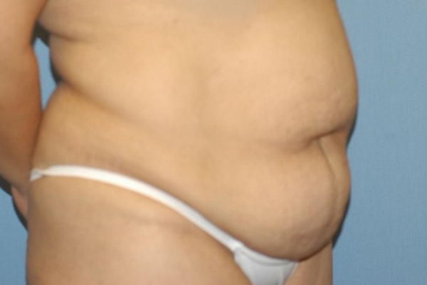 Tummy Tuck Before & After Gallery - Patient 173566425 - Image 3