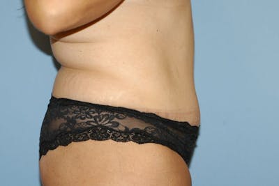 Tummy Tuck Before & After Gallery - Patient 173566425 - Image 6