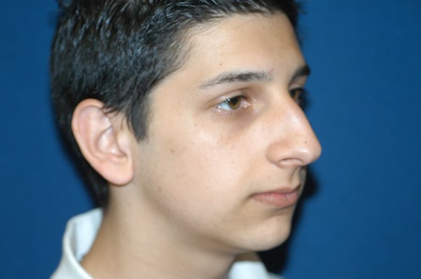 Rhinoplasty Before & After Gallery - Patient 173566430 - Image 5