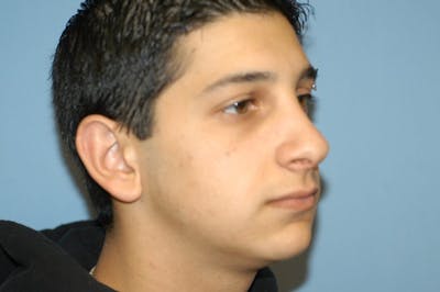 Rhinoplasty Before & After Gallery - Patient 173566430 - Image 6