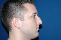 Rhinoplasty Before & After Gallery - Patient 173566435 - Image 1