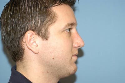 Rhinoplasty Before & After Gallery - Patient 173566435 - Image 2