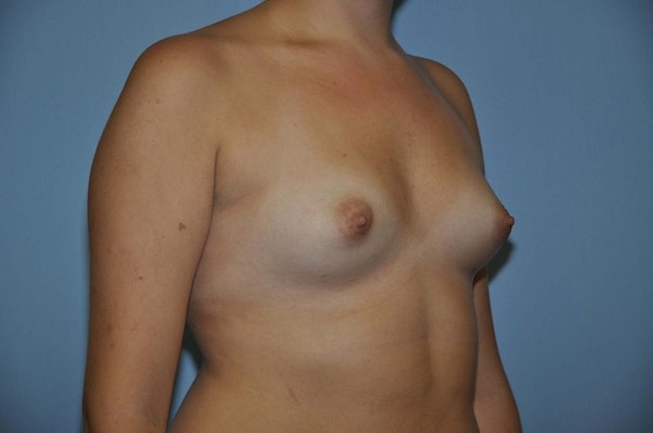 Breast Augmentation Before & After Gallery - Patient 173566433 - Image 3