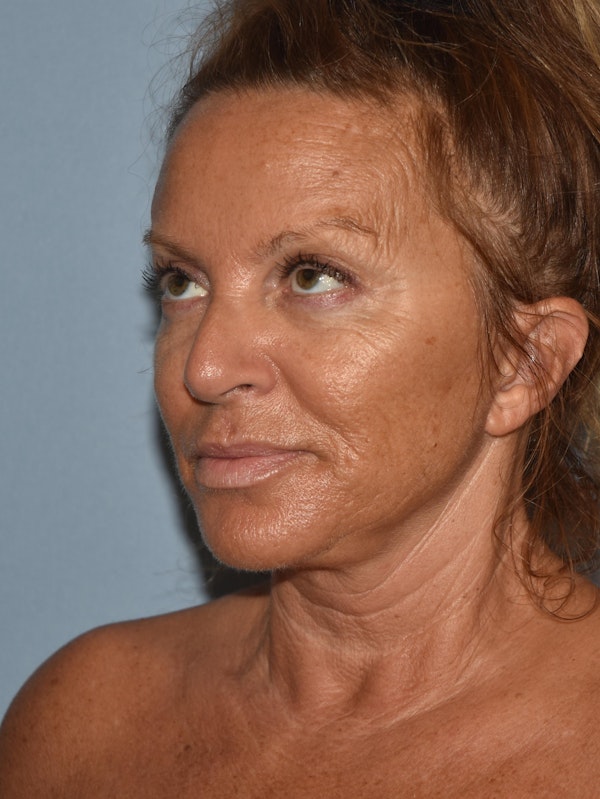 Facelift Before & After Gallery - Patient 173566432 - Image 6