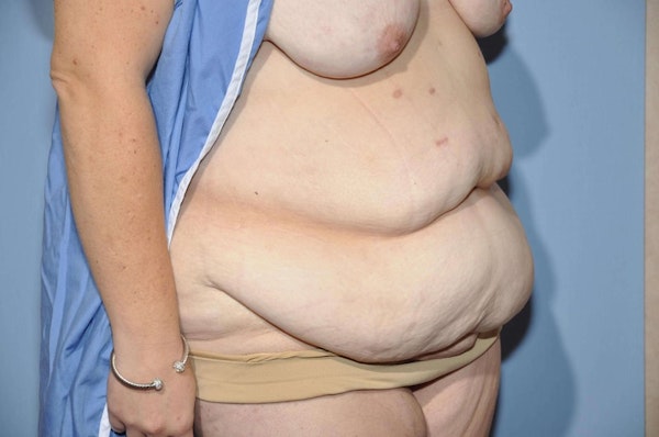 Tummy Tuck Before & After Gallery - Patient 173566436 - Image 3