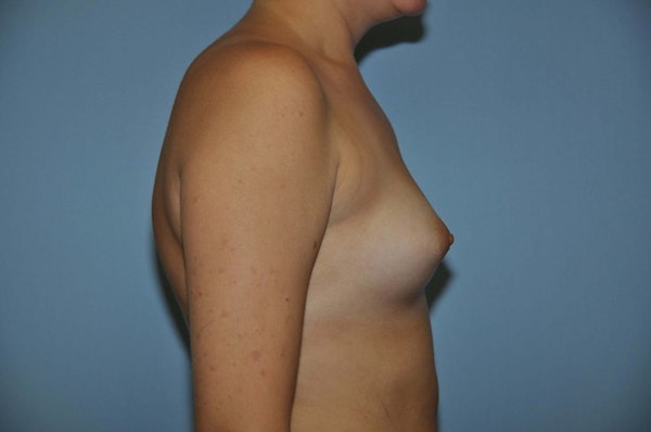 Breast Augmentation Before & After Gallery - Patient 173566433 - Image 5