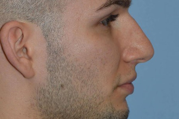 Rhinoplasty Before & After Gallery - Patient 173566439 - Image 1