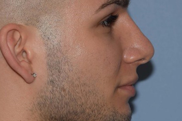 Rhinoplasty Before & After Gallery - Patient 173566439 - Image 2