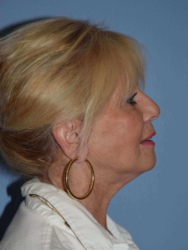 Facelift Before & After Gallery - Patient 173566460 - Image 4