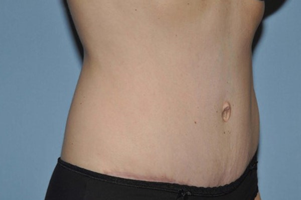 Tummy Tuck Before & After Gallery - Patient 173566456 - Image 4