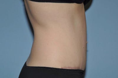Tummy Tuck Before & After Gallery - Patient 173566456 - Image 6