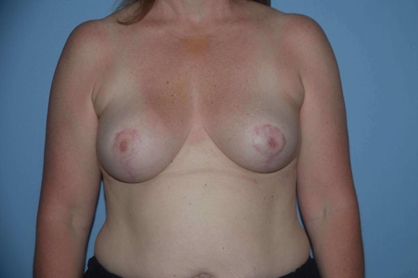 Breast Reduction Before & After Gallery - Patient 173566464 - Image 2