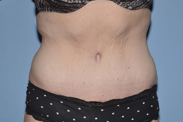 Tummy Tuck Before & After Gallery - Patient 173566469 - Image 2