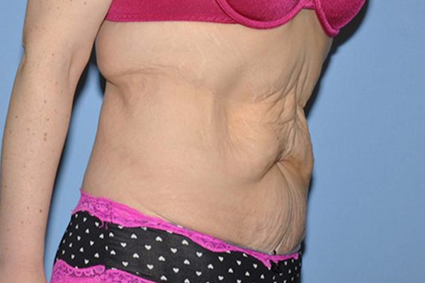 Tummy Tuck Before & After Gallery - Patient 173566469 - Image 3