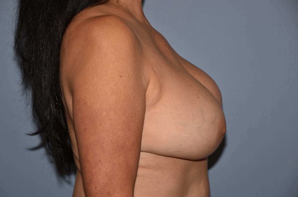 Breast Revision Before & After Gallery - Patient 173566467 - Image 5