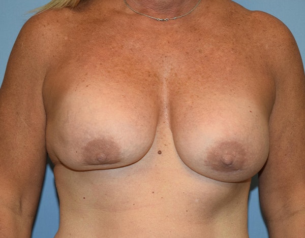 Breast Revision Before & After Gallery - Patient 173566491 - Image 1
