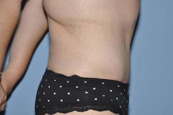 Tummy Tuck Before & After Gallery - Patient 173566469 - Image 6