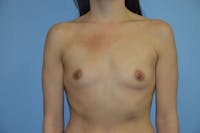 Breast Augmentation Before & After Gallery - Patient 173566511 - Image 1