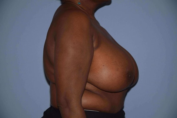 Breast Reduction Before & After Gallery - Patient 173566472 - Image 5