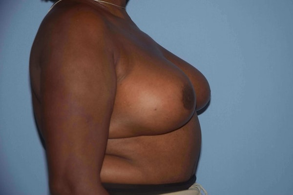 Breast Reduction Before & After Gallery - Patient 173566472 - Image 6