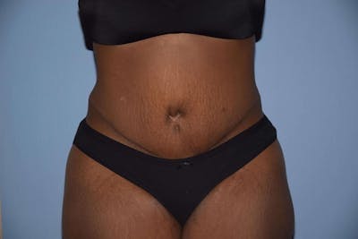 Tummy Tuck Before & After Gallery - Patient 173566521 - Image 2