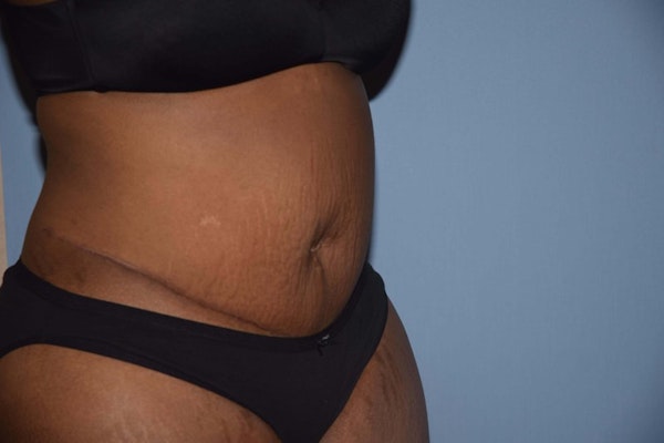 Tummy Tuck Before & After Gallery - Patient 173566521 - Image 4