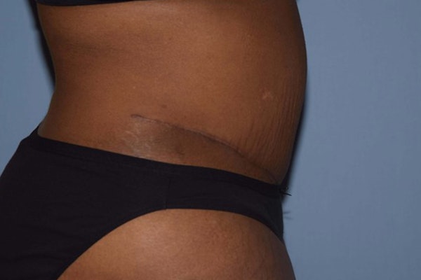 Tummy Tuck Before & After Gallery - Patient 173566521 - Image 6