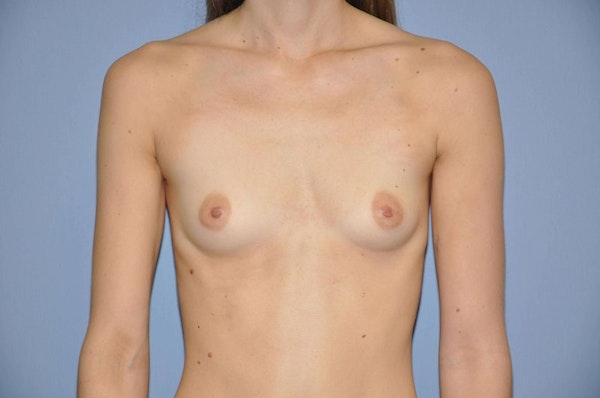Breast Augmentation Before & After Gallery - Patient 173566705 - Image 1