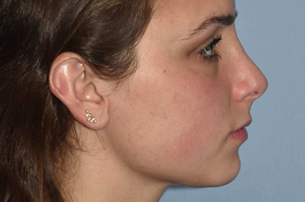 Rhinoplasty Before & After Gallery - Patient 173566701 - Image 2