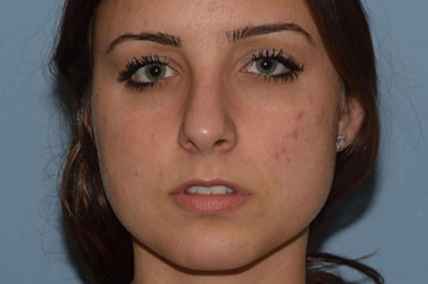 Rhinoplasty Before & After Gallery - Patient 173566701 - Image 3