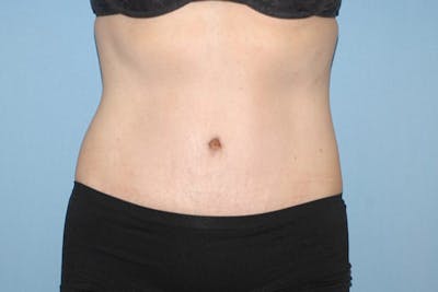 Tummy Tuck Before & After Gallery - Patient 173566737 - Image 2