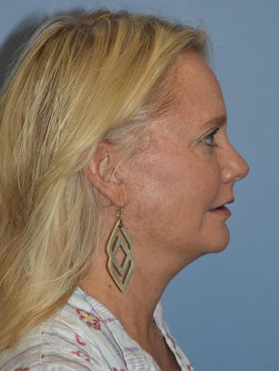 Facelift Before & After Gallery - Patient 173566725 - Image 6